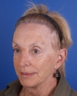 After Hair Transplant&nbsp;Hair Thinning